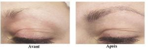 avant apres onco sourcils